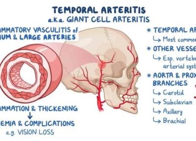 چرا سردرد شقیقه پس از 50 سالگی همواره باید جدی گرفته گردد؟